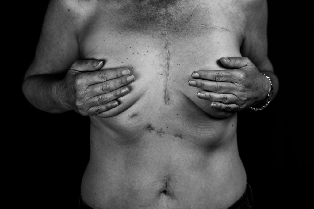 Women's chest shows scars while hands are holding chest.