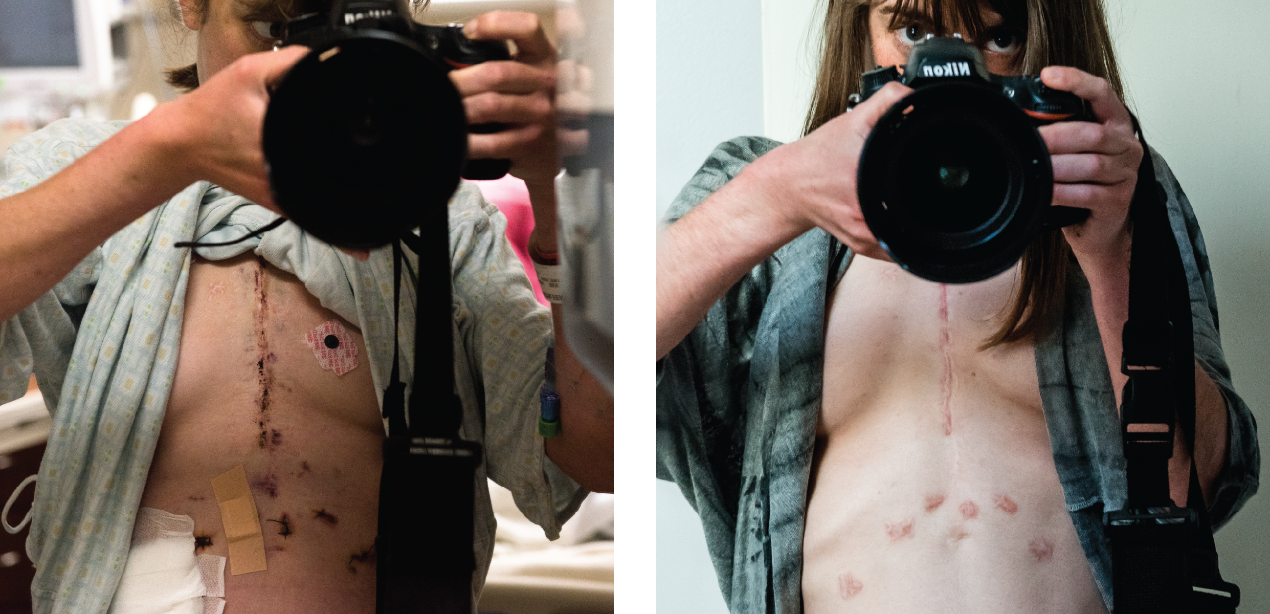 Two images of white woman holding up black camera showing scar marks on chest and stomach.