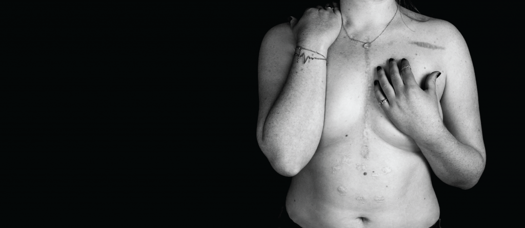 Woman's chest shows scars with left hand near neck and right hand resting on upper chest.